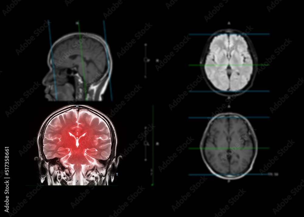 MRI  brain showing coronal plane of the brain  .