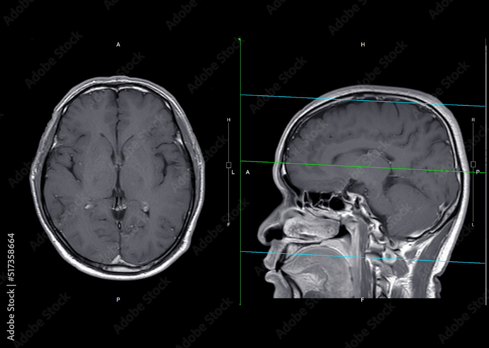 MRI brain axial and sagittal plane with gadolinium contrast Stock Photo ...