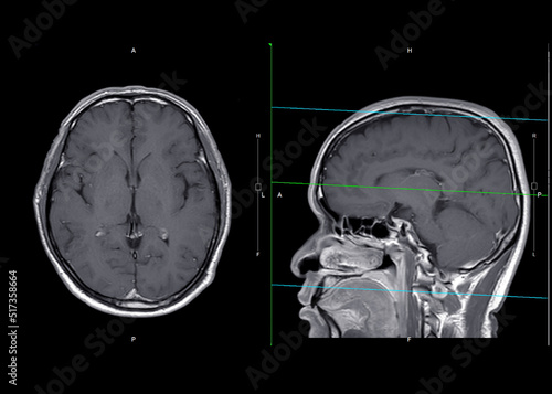 MRI  brain axial and sagittal plane with gadolinium contrast photo