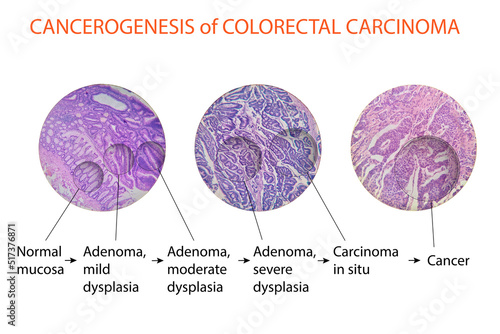 Cancerogenesis of colorectal carcinoma photo