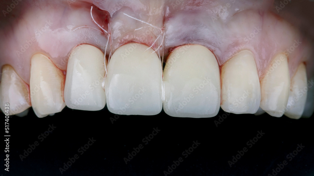 Obraz premium installed temporary dental crown of the central tooth on the abutment with suturing