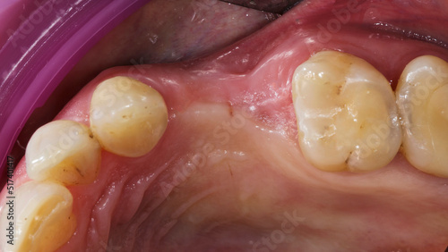 gum cavity without two teeth before implantation