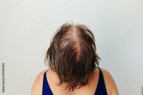 Hair loss in the form of alopecia areata. Bald head of a woman. Hair thinning after covid. Bald patches of total alopecia
