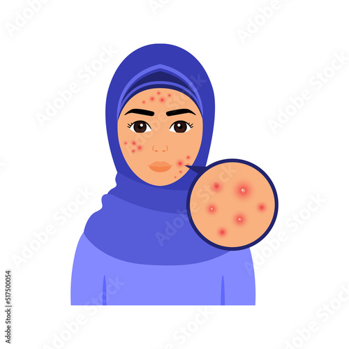 Beautiful Muslim Woman with Pimples on Female Face. Pretty Lady in Hijab and with Problem Skin. Acne. Zoom. Color Cartoon style. White background. Vector illustration for Medical and Beauty Design.