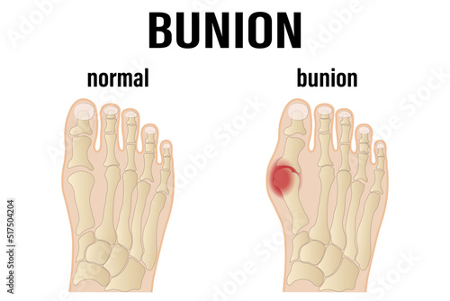 osteoarthritis, rheumatoid arthritis and post-traumatic arthritis. comparison of the human foot with common forms of arthritis. inflamed synovium and joint deformity photo