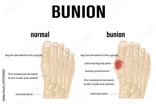 osteoarthritis, rheumatoid arthritis and post-traumatic arthritis. comparison of the human foot with common forms of arthritis. inflamed synovium and joint deformity