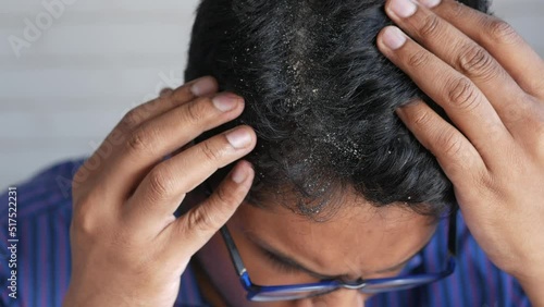 men with dandruff in his hair, closeup 