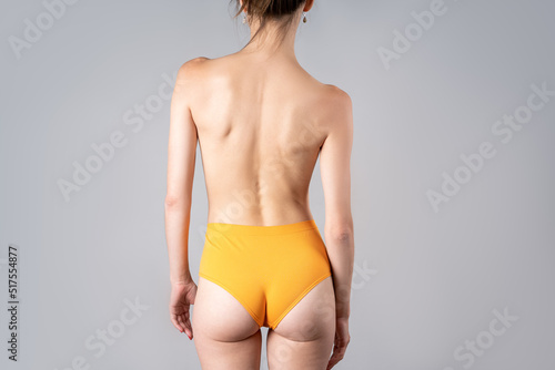 Naked female back, slim topless woman in yellow panties on gray background, body care and correction of scoliosis concept photo