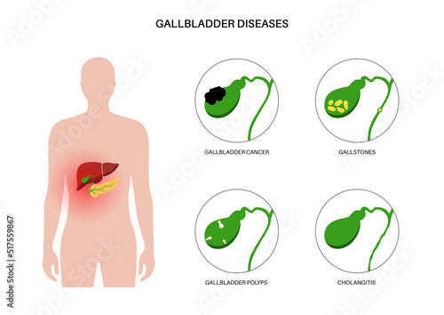 Gallbladder diseases poster