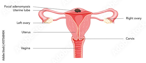 Focal Adenomyosis with inscriptions, Human anatomy Female reproductive Sick system organs. Structure of uterus, cervix, ovary, fallopian tube in Latin text. Frontal view in a cut Vector illustration