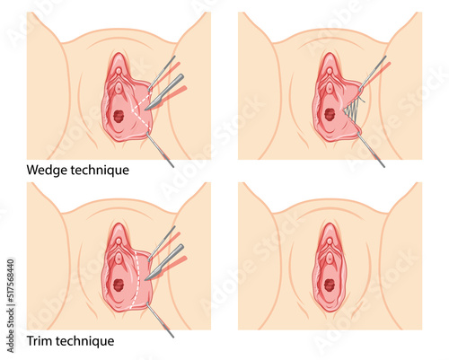 Labiaplasty Female reproductive system process and ready uterus. Vaginoplasty Front view. Human Surface anatomy of the perineum external organs location scheme, vagina pain vulva flat style icon photo