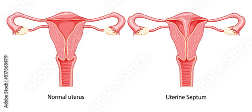 Set of Uterine septum septate uterus normal and with disease Female reproductive system diagram. Front view in a cut. Human anatomy scheme, cervix flat style icon Vector medical illustration isolated