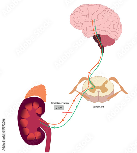 Renal denervation changes in the nervous system during the efferent and afferent process. RDN treatment for hypertension. 