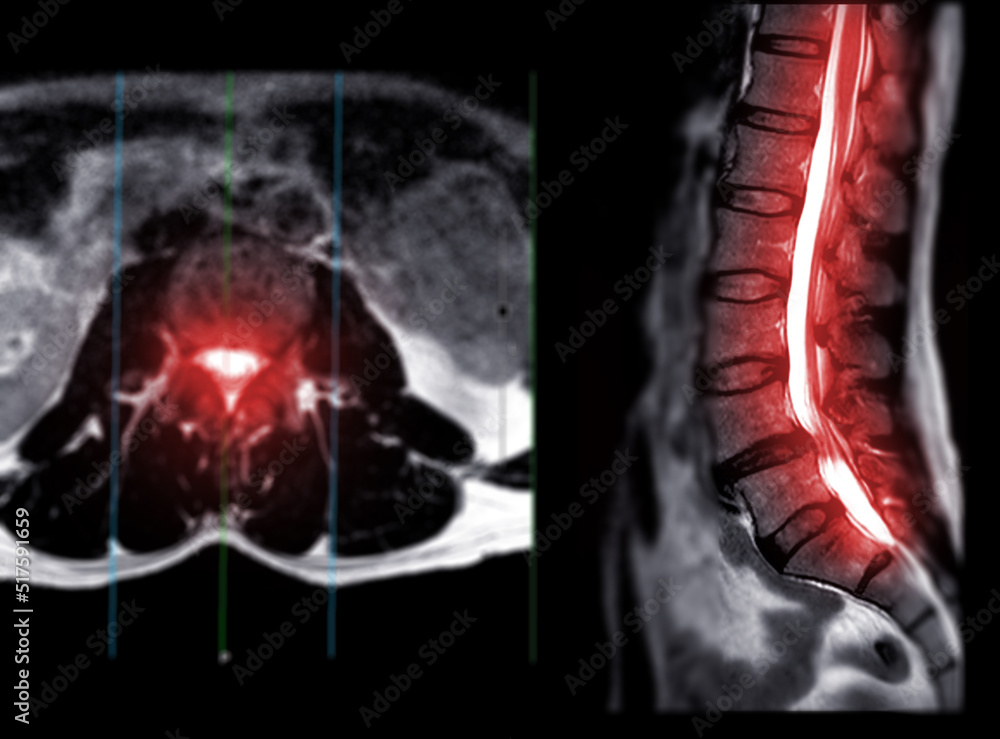 MRI L-S spine or lumbar spine Axial T2W view with sagittal plane ...