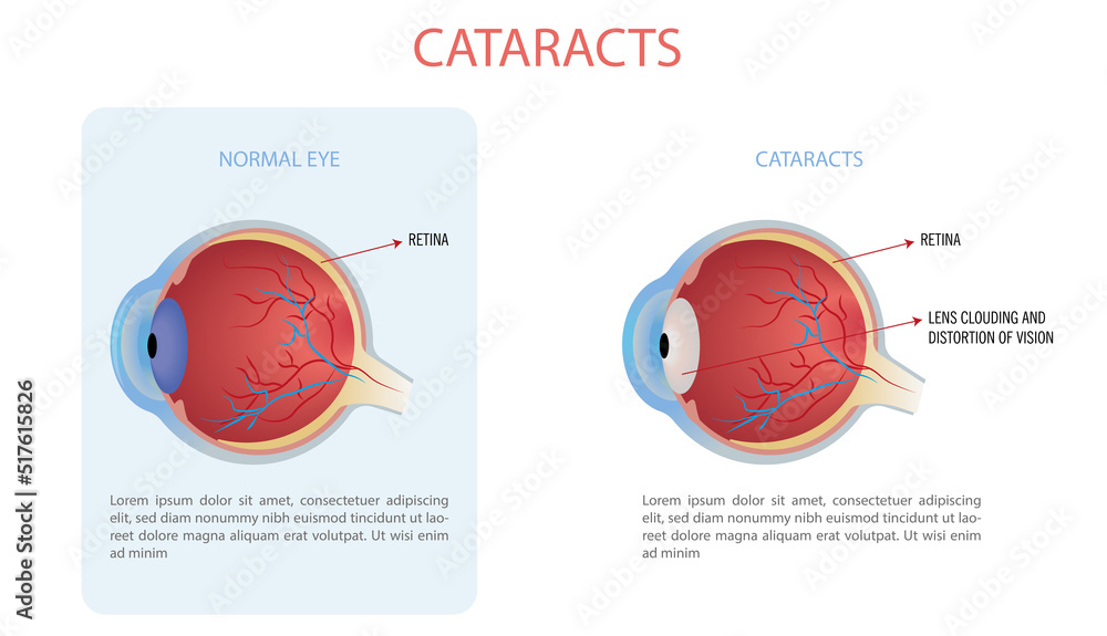 Vector illustration of cataract, cataract is a clouding of the lens of the eye that causes a loss of vision. - obrazy, fototapety, plakaty 