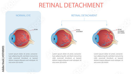 Infographic of a normal eye and an eye with retinal detachment, two types with and without tear.
