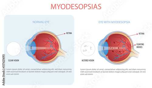 Infographic of a normal eye and myodesopsic eye, also known as floaters or floating bodies.