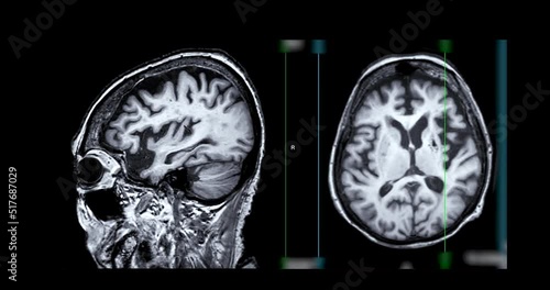 MRI of the brain compare sagittal and axial plane  for diagnosis stroke diseases. photo