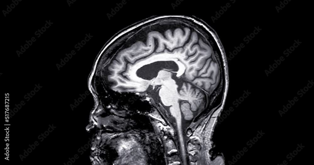 MRI of the brain sagittal plane for diagnosis stroke diseases. Stock ...