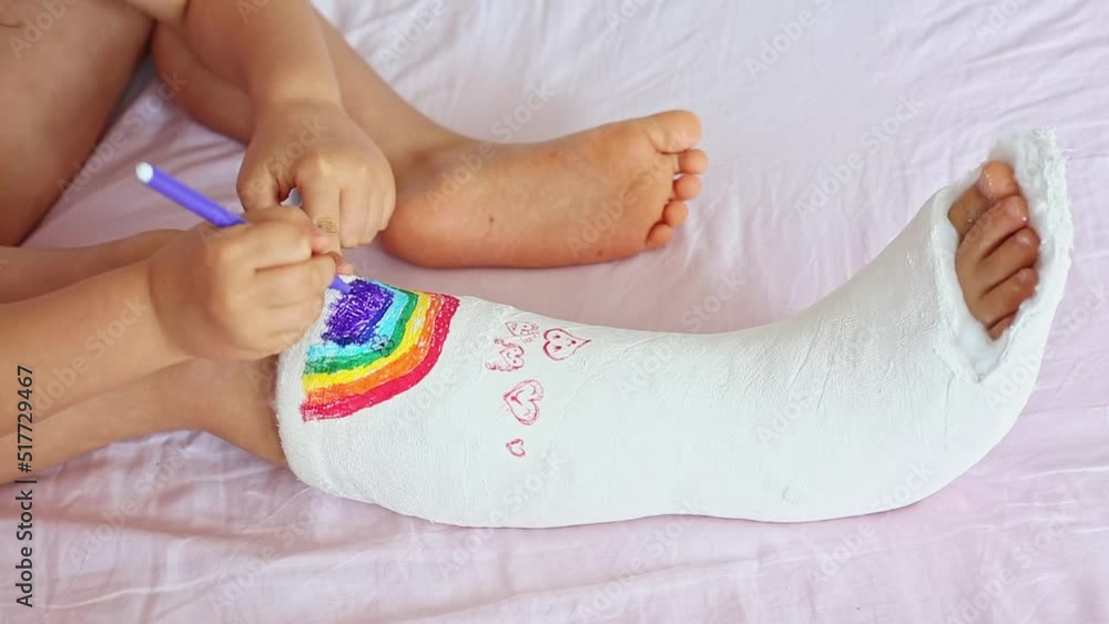 A unrecognizable little girl with a broken leg at home on the bed draws