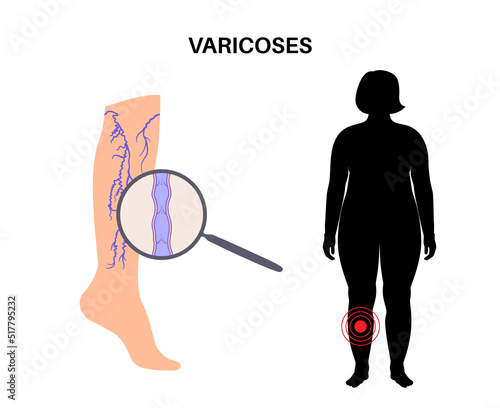 Varicose veins treatment