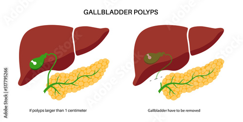 gallbladder anatomy poster
