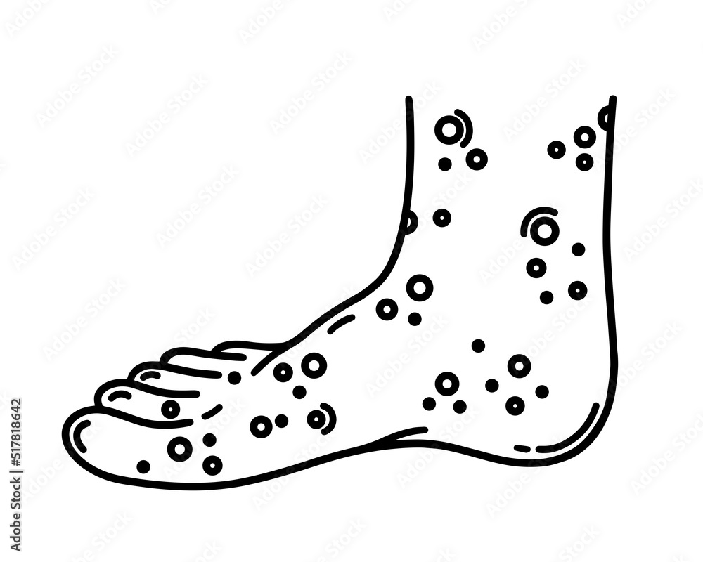 Painful rash on the right human foot. Leg with ulcers, blisters, sores