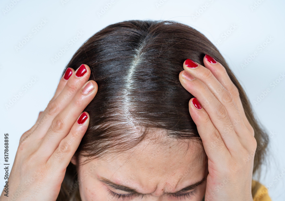 Fototapeta premium Close up of Asian woman worrying about her forehead with part of her thin hair, she had hair loss problem.