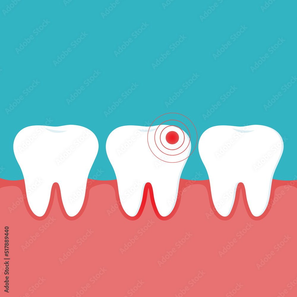 Illustration of an inflamed tooth and gum and healthy teeth. Gingivitis. Concept for dental clinics and oral care brochures. Illustration of an inflamed tooth and gum and healthy teeth. Gingivitis. Concept for dental clinics and oral care brochures.