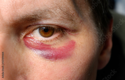 Foto Bruise and swelling from a blow on the face of a man close-up