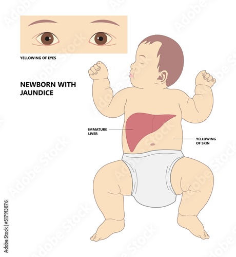 Liver disease in newborn jaundice with exchange transfusion of pediatric nursing care light therapy Biliary atresia