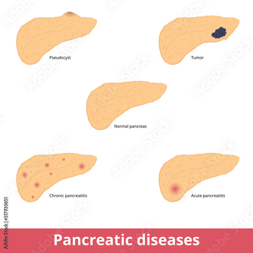 Pancreatic diseases. Visualization of common pancreatic diseases including pseudocyst, tumor, chronic and acute pancreatitis.