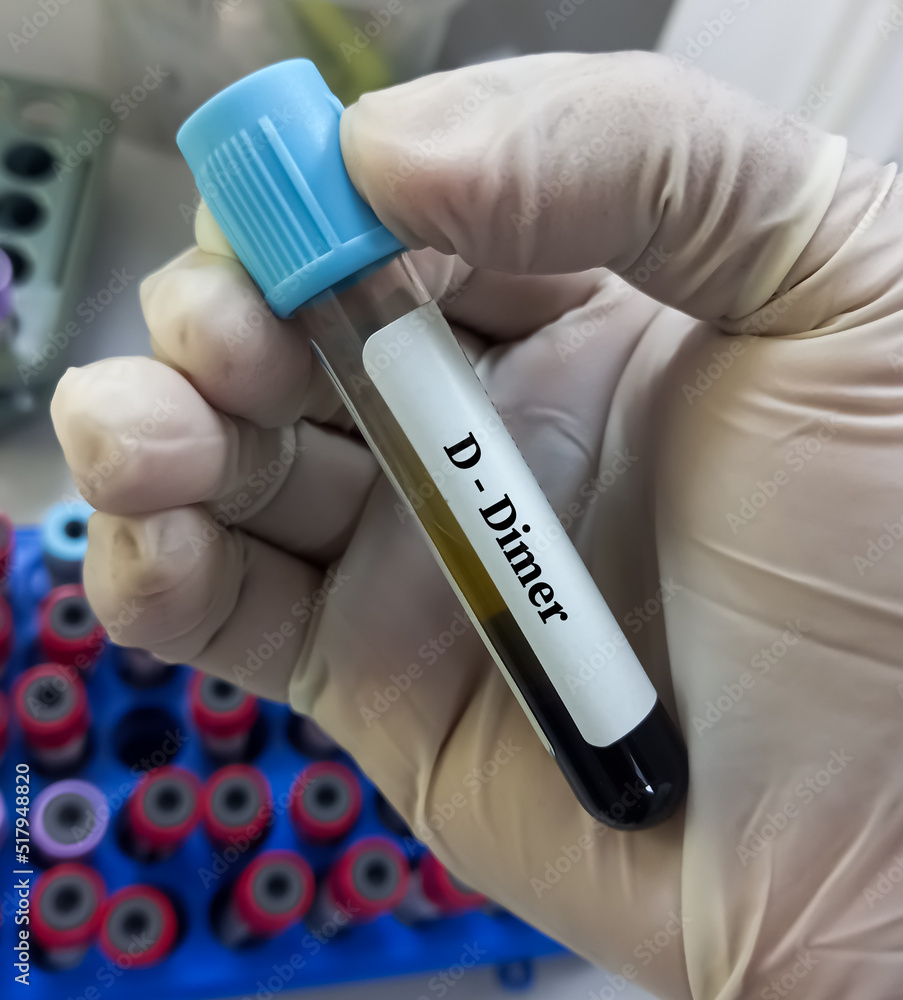 DDimer test. Corona patient monitoring test. Doctor or scientist hold