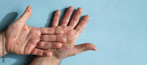 Fotografie, Obraz Male hands with Monkeypox rash