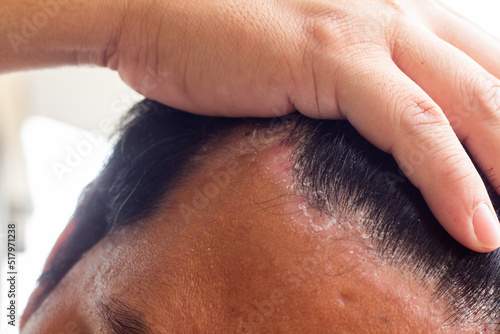 skin disease at the head, Dandruff is a common condition that causes the skin on the scalp to flake photo