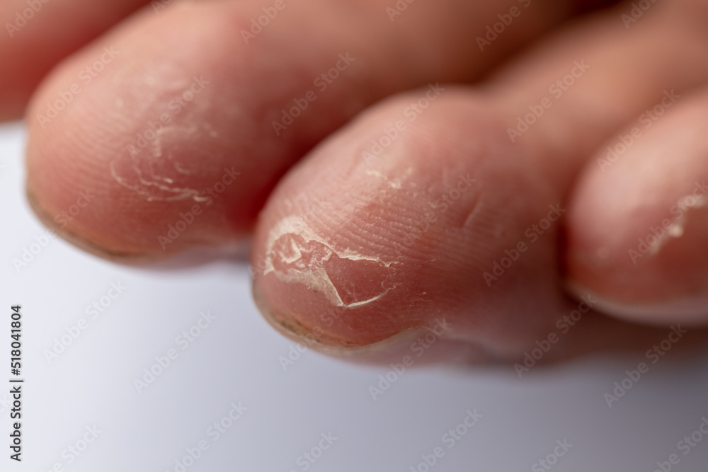 Fototapeta premium Pattern of Atopic eczema and fungal diseases on the human body.