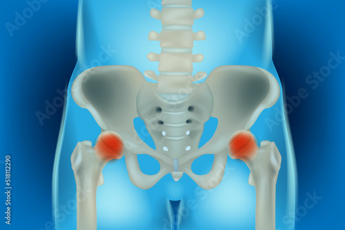 Bones of the pelvis and hip, human anatomy, femur bone joint pain, X ray of the hip joint and femur. Osteonecrosis of the Hip. 3d illustration