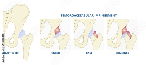 Types of hip bone Pain range of motion with head tear groin Treat joint thigh femur injury spurs socket lesion