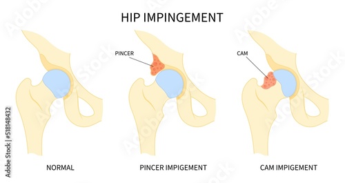 Impigement syndrome of hip bone Pain range of motion with head tear groin Treat joint thigh femur injury spurs socket lesion