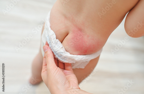 irritation on the skin of the baby from the diaper photo
