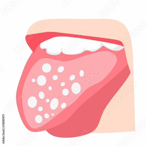 Vector illustration. Dry throat as a sign to commemorate Sjogrens day. on a white background.