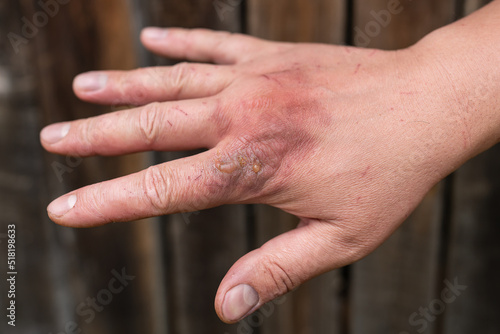 Foto First degree skin burn