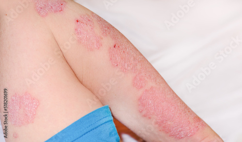 Acute psoriasis on the arm of a man, severe redness on the skin, an autoimmune incurable dermatological skin disease. Red redness, spots on the skin.Large red inflamed scaly rash on the hands. photo