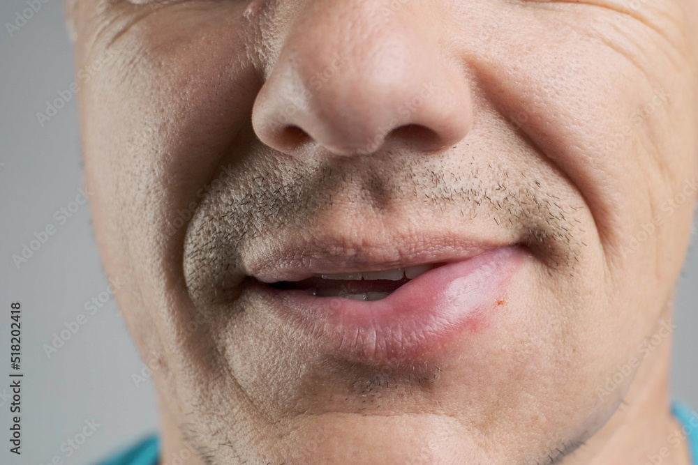 Allergic reaction to a bee sting. An unshaven man was stung by a bee. Edema, swelling of the lower lip in the stung area close-up Allergic reaction to a bee sting. An unshaven man was stung by a bee. Edema, swelling of the lower lip in the stung area close-up