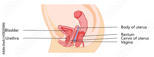 Uterine prolapse Female reproductive system uterus labeled in Anatomical infographic. Side view in a cut. Human anatomy internal organs location scheme flat icon. Vector medical illustration