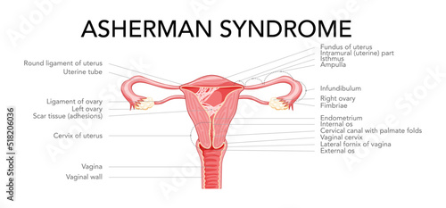 Asherman syndrome Female reproductive system scar tissue adhesions in uterus diagram with inscriptions. Front view in a cut. Human anatomy internal organs location scheme, cervix ovary flat style icon