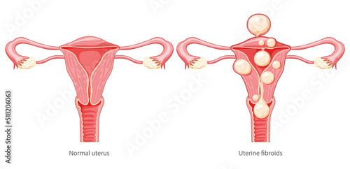 Set of Uterine fibroids Female leiomyomas reproductive system uterus normal and with disease pain. Human anatomy medical illustration isolated internal organs location scheme, cervix flat style icon