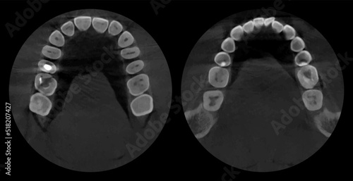 Teeth, realistic 3D scan jaw, dental MRI with caries, scanner picture. Dental x-ray examination graphic, new technologies in dentistry. Vector illustration