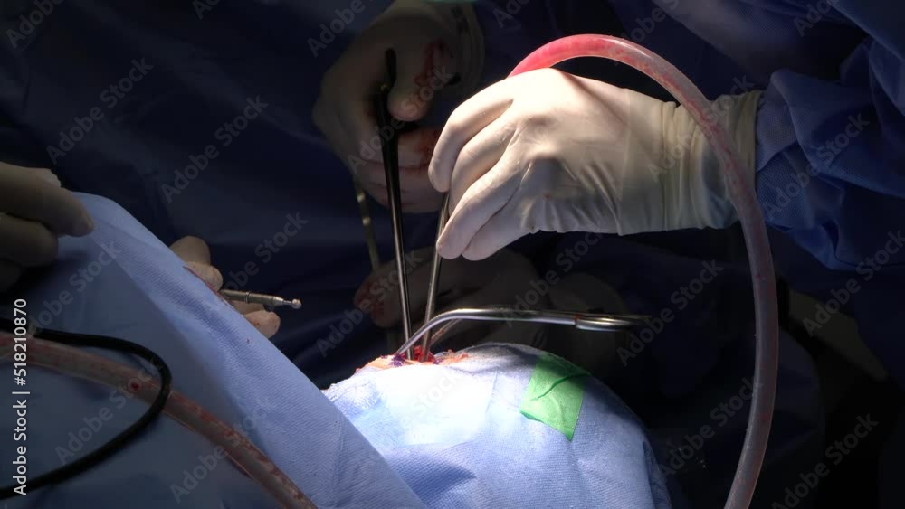 Video Stock Neurosurgery or neurological surgery, known in common