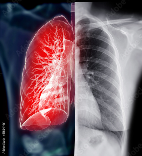 Chest X-ray with Lung 3D rendering  . photo